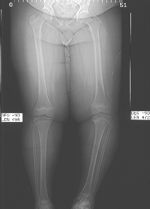 Leg Length Discrepancy