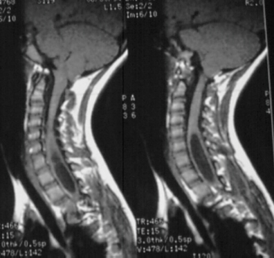 arnold chiari malformation  pictures