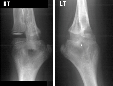 CONGENITAL RADIOULNAR SYNOSTOSIS