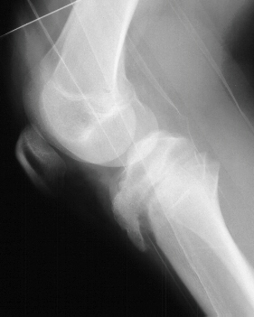 Fracture of the Proximal Tibial Epiphysis